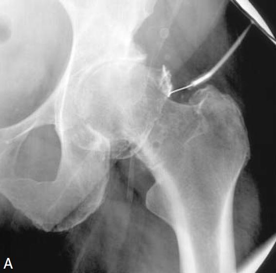 ÚVOD 4 ÚVOD Řada klinických stavů jako artróza, trauma, vrozené či získané kloubní choroby vedou ke ztrátě tkáně kloubní chrupavky.