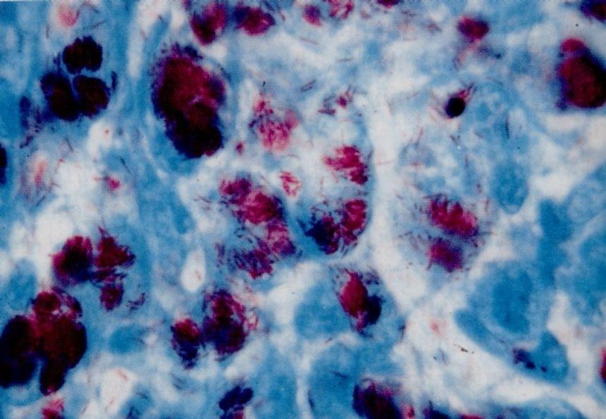 Kyselé barvení fuchsinem -použití pro stanovení mykobakterií (př. Mycobacterium tuberculosis, M. leprae, M.