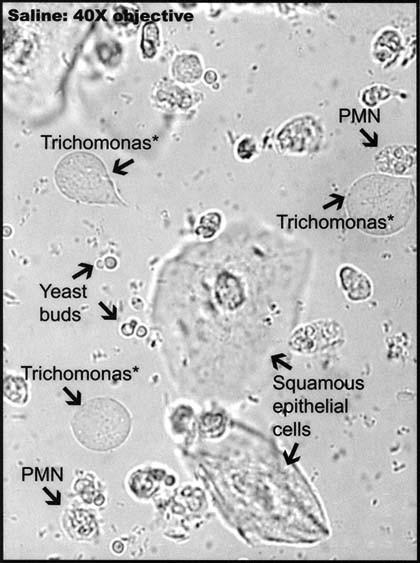 Trichomonas vaginalis http://www.bu.