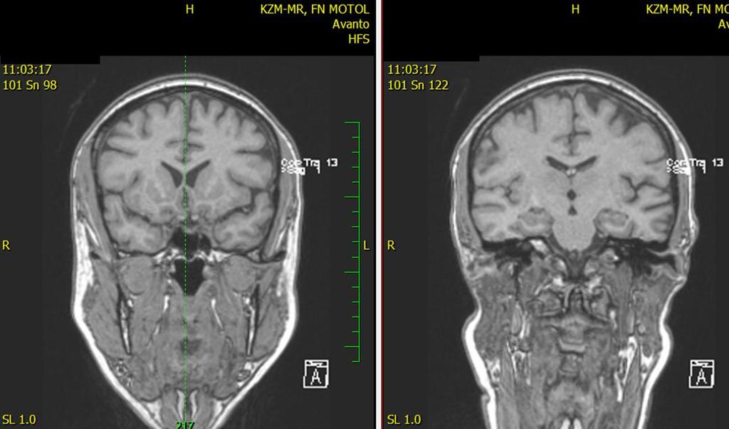 MRI 2/2015: Fazekas 1, GCA 1, Scheltens 0 dx., 0.