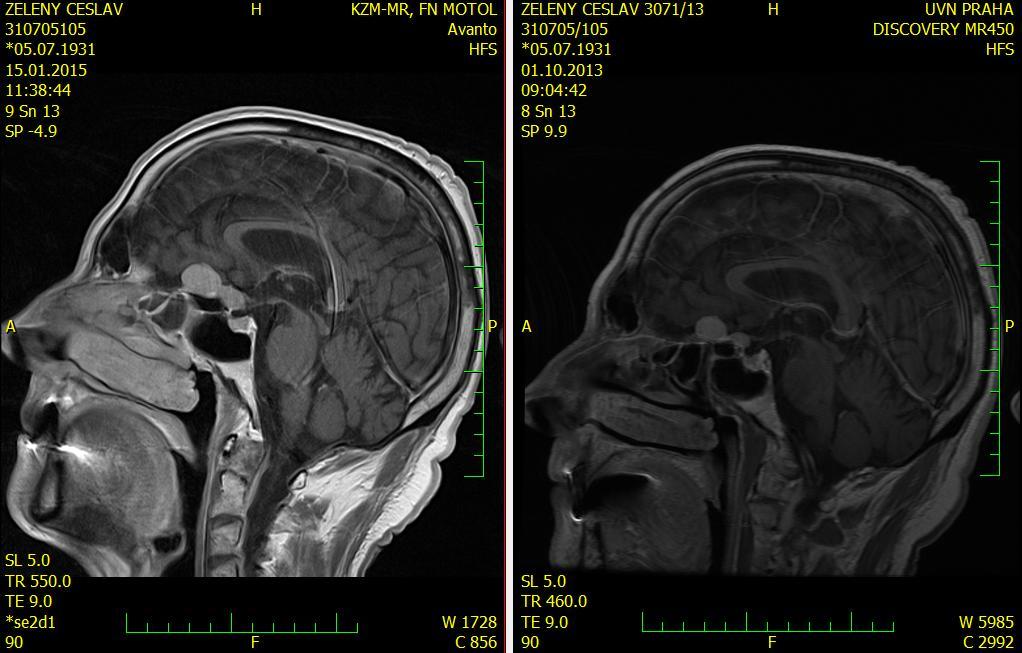 MRI 1/2015: GCA 2, Fazekas 1.