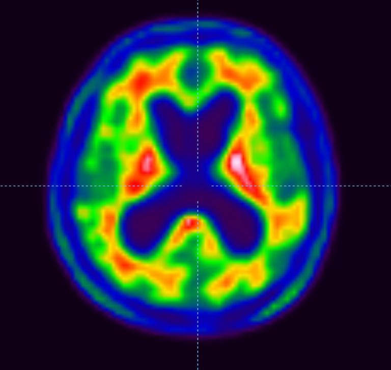 Kazuistika 3 amyloid PET/CT + opakovaný