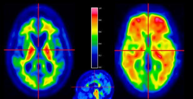 Využití amyloid PET Normální stárnutí Subjektivní stížnosti?