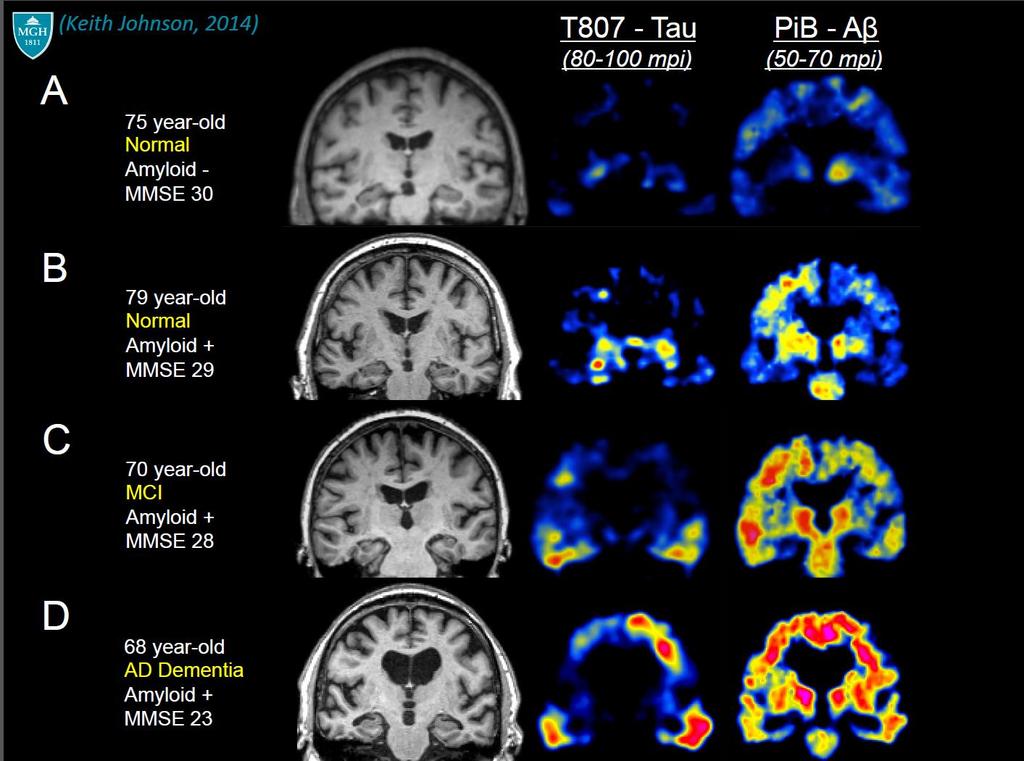 Braak and Braak, 1991; Delacourte et al.