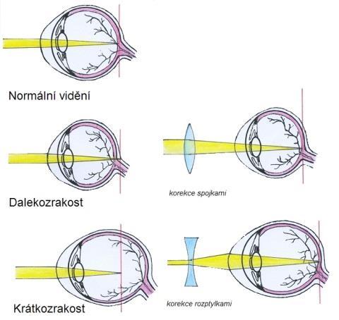 Dělení podle hodnoty refrakce: myopie lehká - od -0,25 do -3,0 dioptrií, myopie střední - od -3,35 do -6,0 dioptrií, myopie vysoká - od -6,25 do -9,0 dioptrií, myopie těţká - od -9,25 a výše. [11] 3.