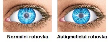 3.1.3 Astigmatismus U astigmatismu nemá oko ve všech rovinách stejnou optickou mohutnost. Nejčastěji to způsobuje různá lomivost jednotlivých rovin rohovky.