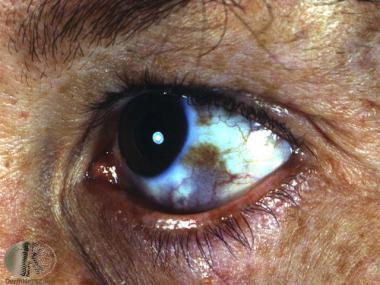 3.2 Nádory oka Oblast oftalmoonkologie zahrnuje široké spektrum nádorů, které mohou vycházet přímo z nitroočních struktur nebo očnice (orbity) nebo z pomocných orgánů oka - z řas, spojivek a jiných