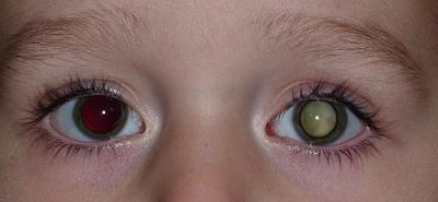 3.2.2 Maligní (zhoubné) nálezy Retinoblastom je prakticky jediným zásadním maligním nádorem oka dětského věku. Mezi malignitami u dětí tvoří cca 3 %.