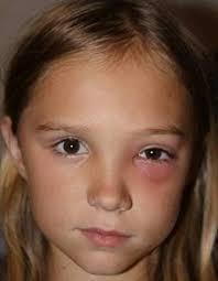 3.3.3 Záněty očnice Orbitocelulitida je jedním z nejčastějších zánětlivých chorob očnice u dětí. Mezi příčiny vzniku řadíme zánět horních cest dýchacích.