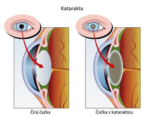 3.4 Vrozené oční vady Vrozené oční vady vznikají jednak v důsledku vývojových poruch, zejména v souvislosti s genetickými poruchami nebo při poškození plodu v děloze zánětem, drogami nebo léčivy. 3.4.1 Kongenitální katarakta Katarakta (šedý zákal) představuje v tomto věku patologické zkalení čočky.