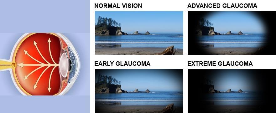 3.4.2 Glaukom Dětský glaukom dělíme: a) primární - se vyskytuje od narození do 3.