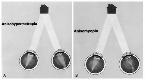 3.4.4 Anizometropie Anizometropie je stav, kdy refrakce pravého a levého oka je rozdílná. Základní typy anizometropie jsou: 1. anizometropie hypermetropická (anisometropia hypermetropica) 2.