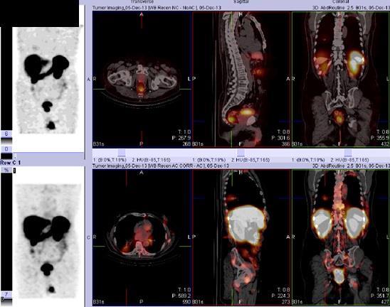 USG, punkce pod USG kontrolou Scintigrafie nádorů 111 In octreotid Indikace: K vyšetření indikován pacient s prokázaným neuroendokrinním tumorem, suspektně karcinoid, metastatické postižení jater,