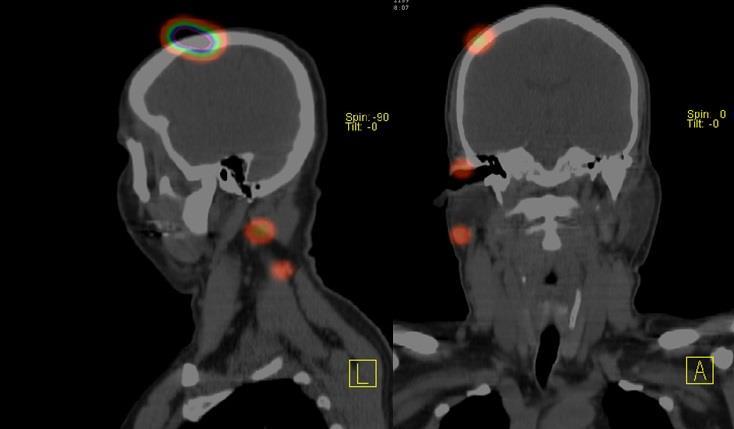 Obrázek č. 4: SPECT/CT sentinelové uzliny Zdroj: WinMedicalc FN Plzeň Lochotín Během operace maligního melanomu hlavy byly pacientovy odebrány 2 lymfatické uzliny z celkem 5 zobrazených.