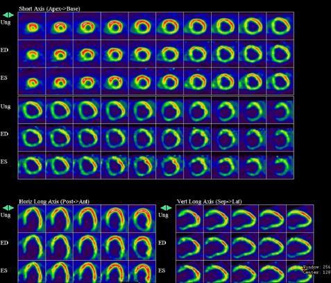 PET/CT viabilita myokardu s 18 FDG Indikace: provedení PET/CT viability myokardu u našeho pacienta s progredující námahovou dušností, vyšetřován na plicní klinice, kde stav hodnocen jako
