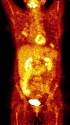 Pacientka byla na základě PET/CT vy