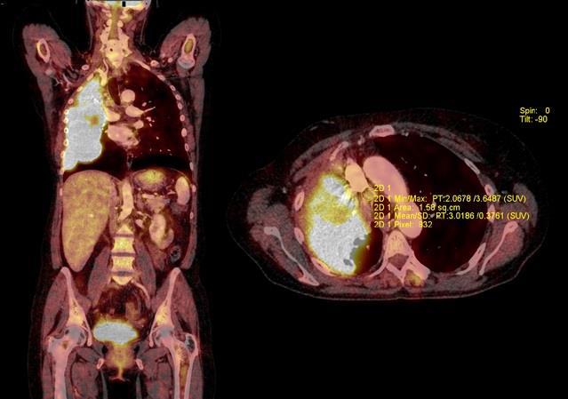 PET/CT trupu s 18 FDG s k.l. i.v.