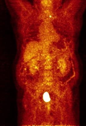 akumulaci FDG bez zřetelných metabolicky aktivních ložisek. Ostatní nález bez podstatné změny, včetně podezření na tumor levé ledviny a metabolicky aktivního uzlu ve štítné žláze. Obrázek č.