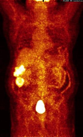 Obrázek č. 12: PET/CT s FDG Zdroj: Winmedicals FN Lochotín USG krku Závěr: Stav po TTE, lůžko bez patologických expanzí. Patologické lymfatické uzliny na krku nezjištěny.