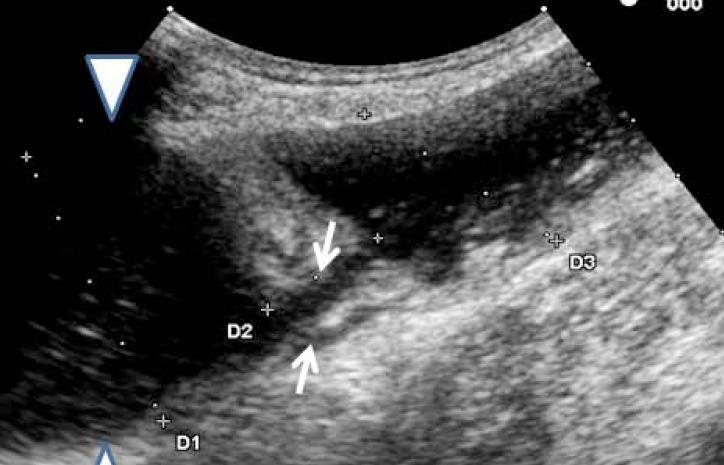 SICUS [Small Intestine Contrast Ultrasound] perorální kontrast