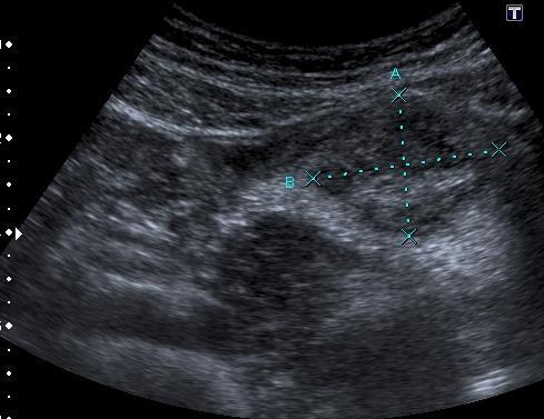 Diagnóza intraabdominálních abscesů Prevalence intrabdominálních abscesů