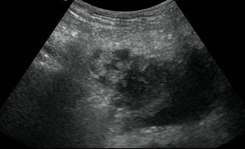 Diferenciální diagnóza abscesů CEUS: významný v odlišení