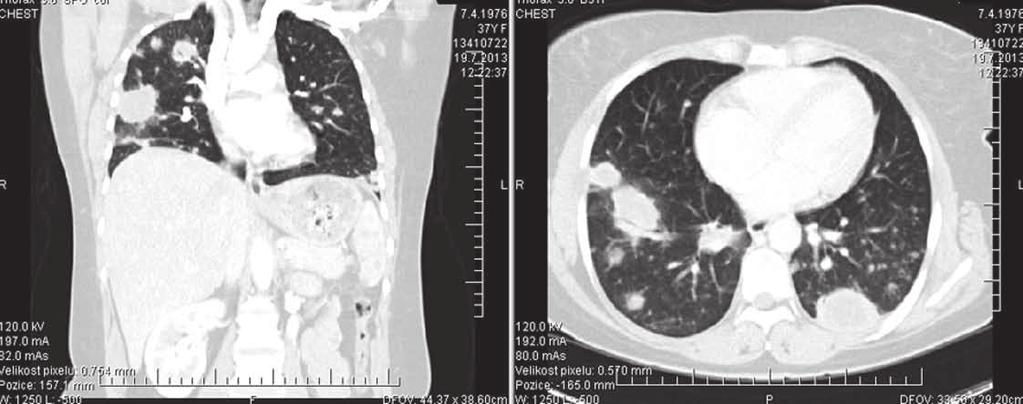 Neobvyklý průběh mnohočetného ložiskového procesu Obr. č. 2: CT vyšetření hrudníku podstoupila transparietální punkci subpleurálně uloženého ložiska pod CT kontrolou.