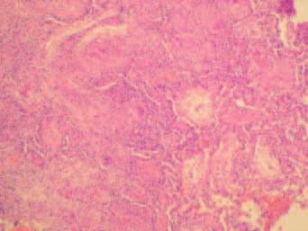 V odebrané tkáni byly popsány nenekrotizující epiteloidní granulomy s obrovskými vícejadernými buňkami Langhansova typu, tedy histologický obraz podporující diagnózu sarkoidózy (obr. 4). V tomto Obr.