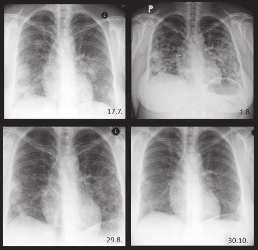 Neobvyklý průběh mnohočetného ložiskového procesu Obr. č. 5: Vývoj radiologického nálezu v čase Langhans Theodor (1839 1919) německý patolog.