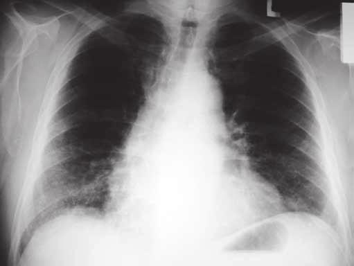 Koincidence plicních nemocí ozáření přístrojem CyberKnife. Postup byl na tamním pracovišti schválen a nemocný následně ozářen v pěti frakcích celkovou dávkou 55 Gy.