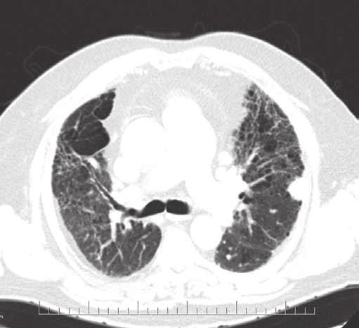 Na skiagramu hrudníku se nově objevil levostranný pneumothorax (obr. č. 3).