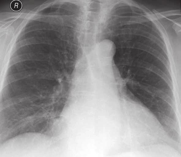 Teoreticky by připadalo v úvahu provést rebiopsii s novým vyšetřením mutací, ale z morálního hlediska bychom zatížili nemocnou dalším vyšetřením a zvláště s minimální pravděpodobností získání