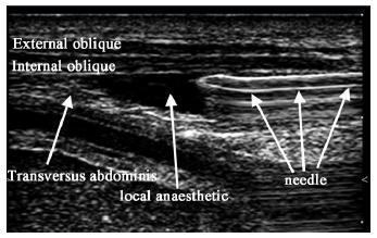 transversus abdominis (Hebbard, Can J Anaesth 2009) Indikace: