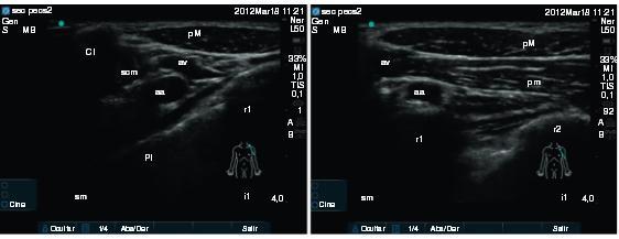 Pecs I, Pecs II, serratus plane blok Aplikace LA mezi m. pectoralis major a minor pod klíčkem Pecs I (Blanco et al, Anaesthesia 2009) Aplikace LA mezi m.