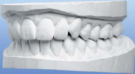 ZHOTOVENÍ MODELU DENTÁLNÍ SÁDRY TYP II MOLDABASTER, MOLDABASTER S Alabastrová sádra pro univerzální použití