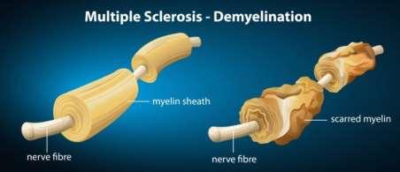 ROZTROUŠENÁ SKLERÓZA SCLEROSIS MULTIPLEX Autor: Frederik Šiška Výskyt Roztroušená skleróza (RS) je chronické autoimunitní demyelinizační onemocnění centrálního nervového systému mozku i míchy.