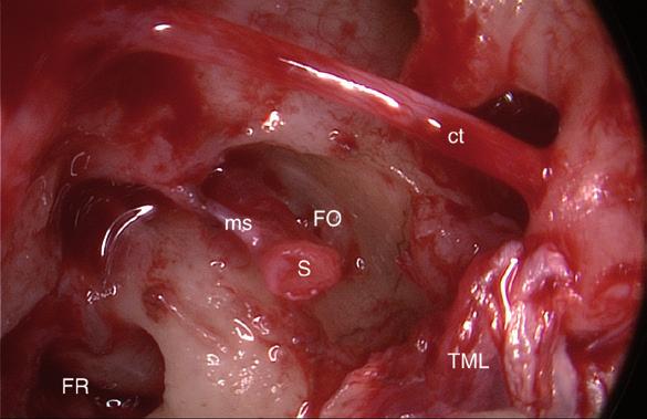 Endoskopická anatomie středního ucha bližší zobrazení středoušních struktur umožňuje lépe porozumět anatomii a fyziologii středouší a