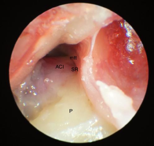Pacientka 28 let, pravé ucho, pohled z mesotympana na istmus tympani (IT istmus tympani, tt šlacha musculus tensor tympani, PC