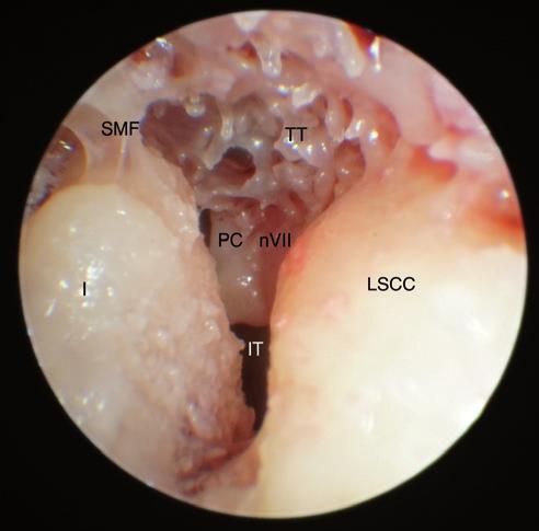 a. carotis interna) Obr. 7: Pohled do středouší endoskopem.