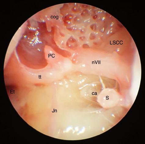 tympani, Jn plexus tympanicus Jacobsoni, PC processus cochleariformis, nvii lícní nerv, ca přední ramínko třmínku, S třmínek, LSCC