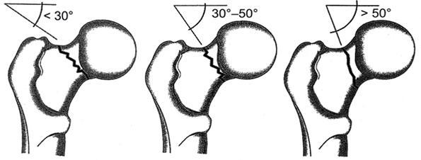 U multifragmentálních zlomeni máme lomné linie: spirální segmentované nepravidelné Zlomeniny krčku se dají rozdělovat podle mnoha faktorů.