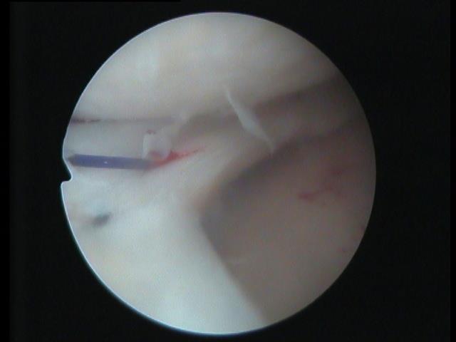 Příznaky: Klasickými příznaky je bolestivost na vnitřní nebo zevní straně kolene v místě kloubní štěrbiny u poškození vnitřního meniskus na straně vnitřní, u zevního na straně zevní.