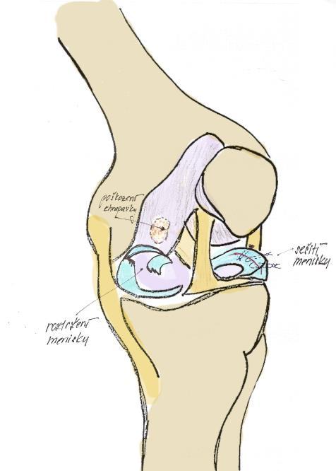 Pacienti udávají v některých případech přeskakování při dřepu, často spojené s bloky kolene u longitudinálních ruptur (tzv. ucho od košíku ), kdy vázne ohyb nebo nažení v kolenním kloubu.