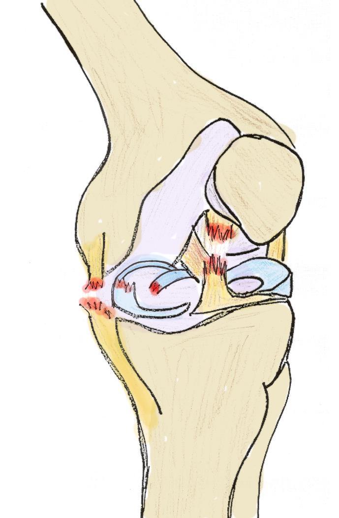 Nešťastná triáda Při velkém násilí působícím na kolenní kloub dochází k poškození i několika struktur najednou.