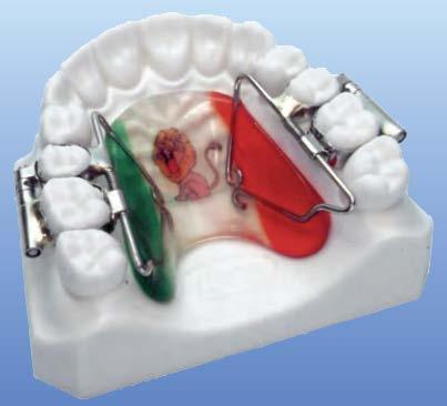 INTERDENT DISTALIZÉRY RaPiD molar DiSTalizéR FiRST class Leone First Class je dokonalým aparátkem pro rychlou kontrolovanou distalizaci horních molárů.