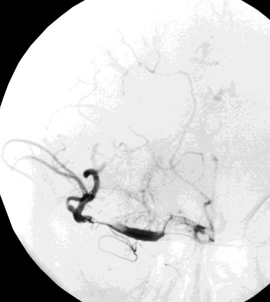 CMP protokol v HK angiografie katetrizační (anesteziolog) čas 4,5 h; (6 h); 8 h;