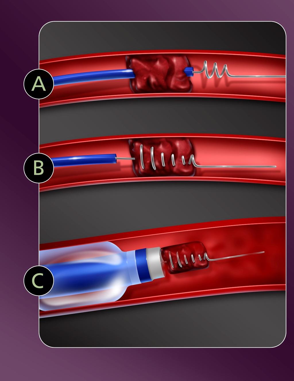 Merci Mechanical Embolus Removal in Cerebral Ischemia FDA schváleno v 2004 Imai K et al. Clot removal therapy by aspiration and extraction for acute embolic carotid occlusion.