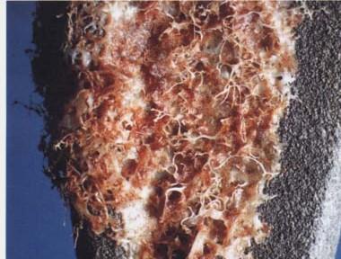 Povrchy implantátů On-growth surface (Ti plasma spray) Hrubost stimuluje osteointegraci Hrubost povrchu- vertikální deviace od ideálního plochého povrchu R a R a 5 µm