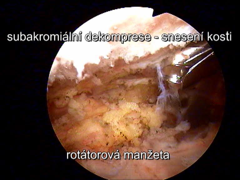 V takovémto případě se provádí artroskopické odstranění dolní části nadpažku (akromioplastika), kde často bývá vrozeně drobný nárůstek.