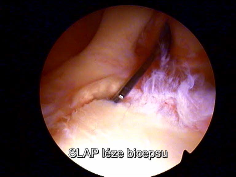 Zde můžeme odtrženou část buď artroskopicky přifixovat, nebo odstranit degenerované tkáně.